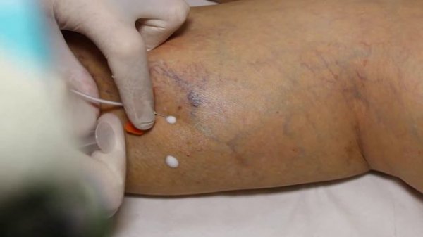 склеротерапия sclerotherapy