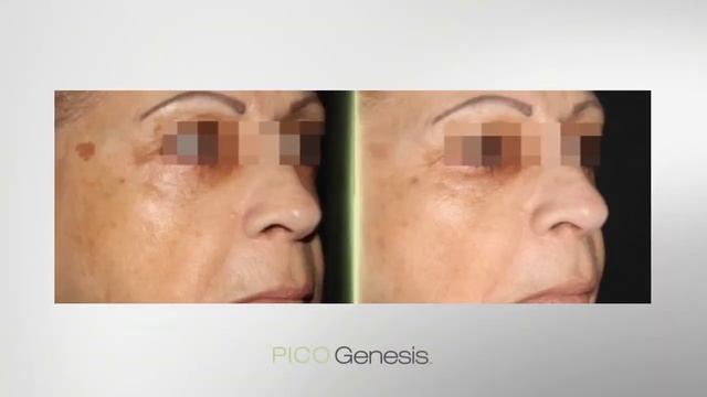 Enlighten PICO Genesis Laser