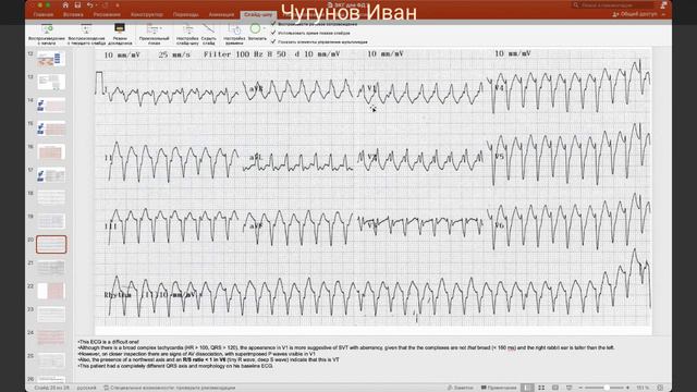 ЭКГ диф. диагностика широко комплексных тахикардий