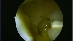 Артроскопия. Удаление мениска при розрыве по типу ручки лейки. Meniscus surgery.