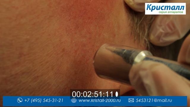 Лазерный аппарат Кристалл, удаление сосудистых звездочек, бородавок смотреть онлайн