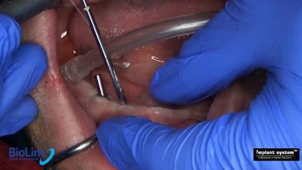 TTPHIL ALL TILT TECHNIQUE DR. VENKAT NAG  BIOLINE