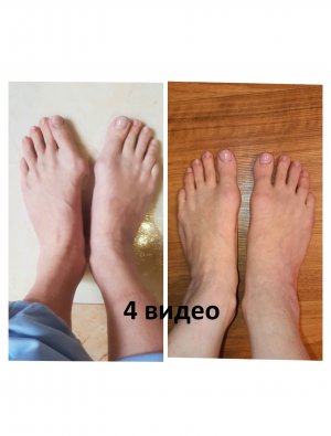 Халюс Вальгус. Ортопедическая Обувь Барука.mp4