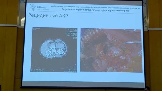 Бохян В.Ю. — Отдаленные результаты хирургического лечения АКР смотреть онлайн