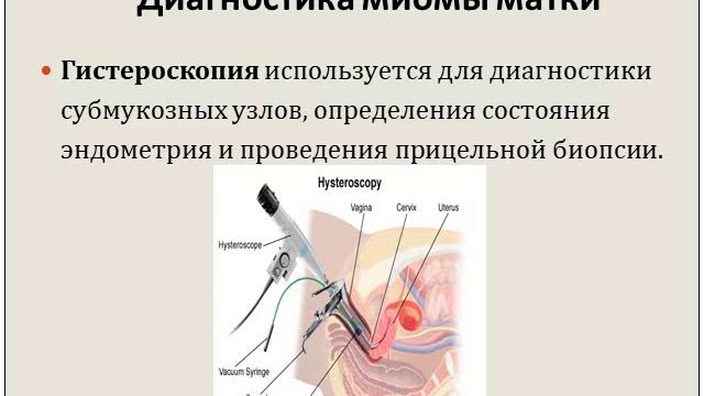 Миома матки. смотреть онлайн