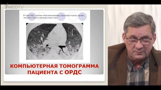 Запись эфира лекции профессора Малявина А.Г. "Острый респираторный дистресс-синдром" смотреть онлайн