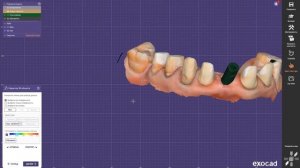 Разборная модель с аналогами имплантов в программе Exocad для 3D печати