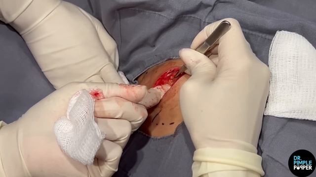 Trickiest Neck Lipoma Dr Pimple Popper Has Encountered In A While!