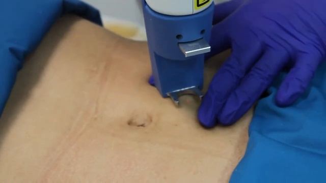 Лазерная эпиляция смотреть онлайн