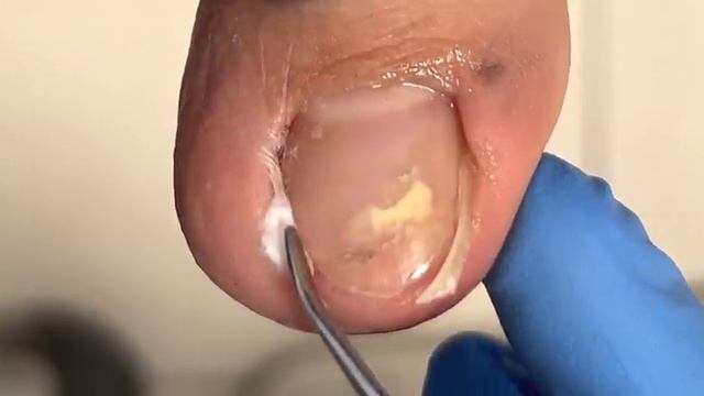Wrongly Grown Ingrown Nails, Hard Nails【Xue Yidao】