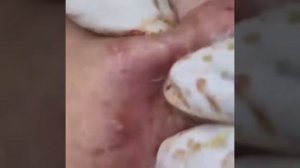 Relax squeezing out blackheads #1 Черные точки