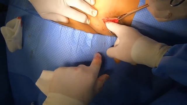 Supraclavicular Mass смотреть онлайн