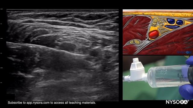 Ultrasound Guided Axillary Brachial Plexus Block NYSORA Regional Anesthesia