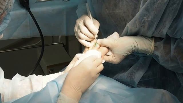 Коррекция молоткообразной деформации 2-го пальца смотреть онлайн