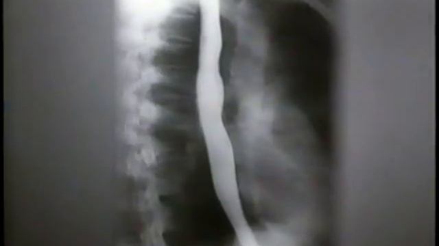 Рентгенологическое исследование пищевода  X-ray examination of the esophagus