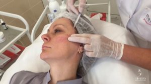 Инъекции Radiesse