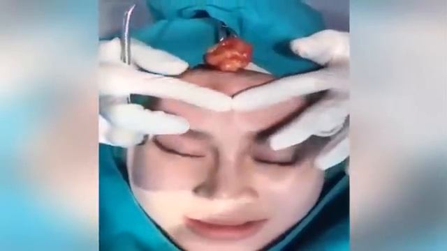 Пальпация и выдавливание гноя из образования на лбу смотреть онлайн