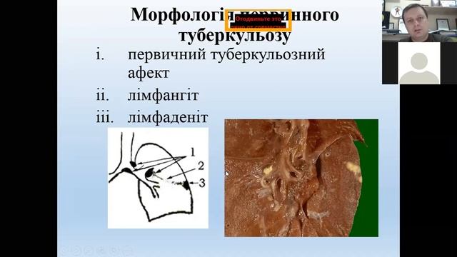 Туберкульоз