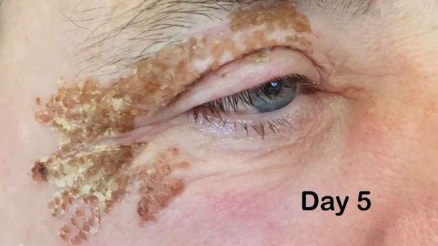 Plasma Pen Upper Eye Lift смотреть онлайн