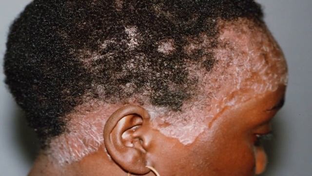 Псориаз кожи головы, симптомы и лечение смотреть онлайн