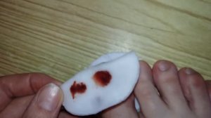 Ушиб пальца, синий ноготь, облегчить боль проколом