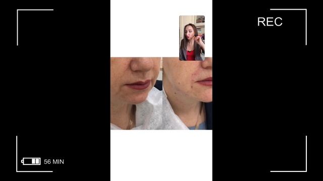 Думаете, вы никогда не избавитесь от брылей? Тогда вас ждет приятный сюрприз! 3 способа. #брыли