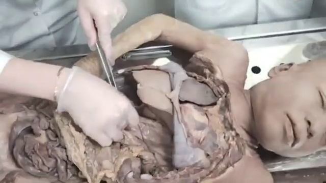 Digestive system ( GIT ) - 03 Part - 1 [ Peritoneum] смотреть онлайн