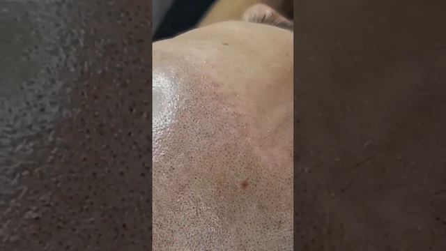 Трихопигментация крупным планом. Результат после второй процедуры. #трихопигментация смотреть онлайн