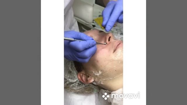 Чистка и дарсонвализация лица смотреть онлайн