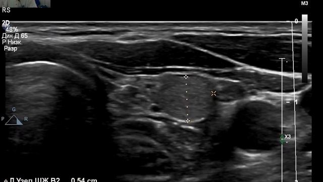 УЗИ щитовидной железы. Крупный узел .ТРАДС 3 и нашелся еще один