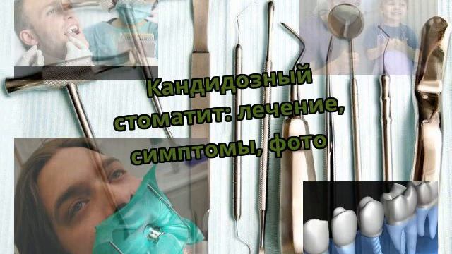 Кандидозный стоматит: лечение, симптомы, фото смотреть онлайн