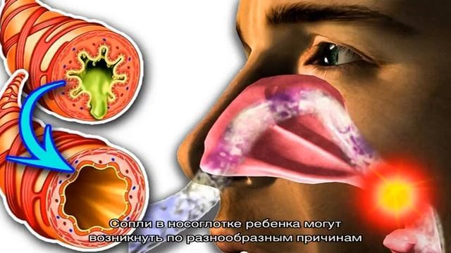 Как избавиться от соплей в горле и носоглотке смотреть онлайн