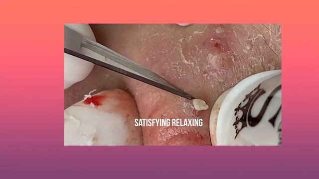 Satisfying Video Blackhead  , Blackhead Removal,Успокаивающее расслабление, удаление черных точек