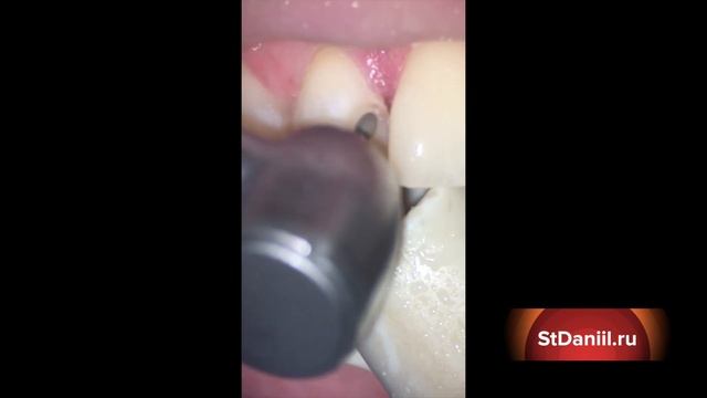Стоматолог Савицкая Юлия Сергеевна. Препарирование некротизированных тканей зуба под микроскопом смотреть онлайн