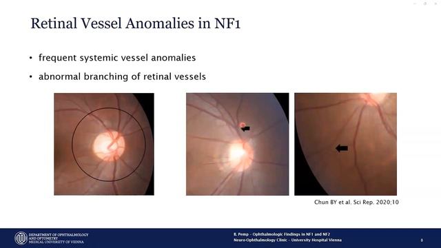 17-Ophtalmologie bei NF1 und NF2-SWN (DE)
