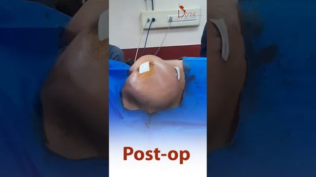 Silicone Implant In Asymmetric Breast