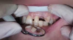 Установка мостовидного зубного протеза, мост