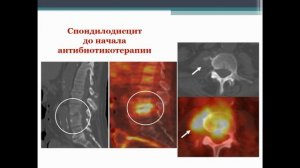 ПЭТ КТ в диагностике инфекции и воспаления