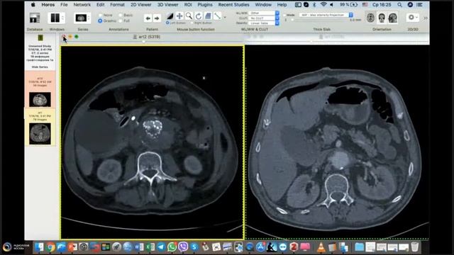 КТ аортография после хирургических вмешательств смотреть онлайн