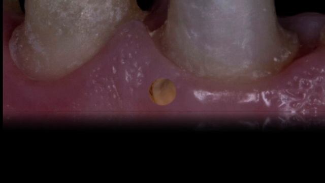 Протезирование зубов , коррекция дёсны , изменение положение и формы зубов , керамические коронки смотреть онлайн