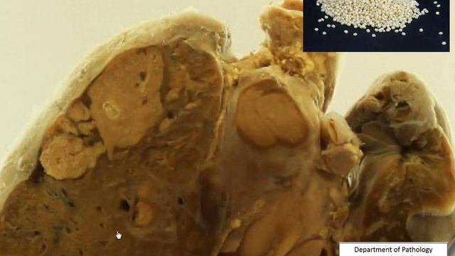 Lung Primary TB смотреть онлайн