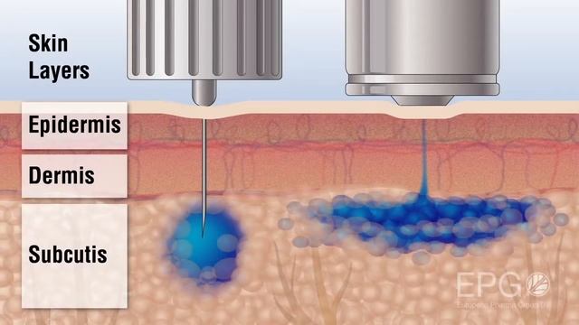 Инъекция из дюзы InsuJet ™ (инсужет) против иглы Needle vs InsuJet™ Nozzle injection смотреть онлайн