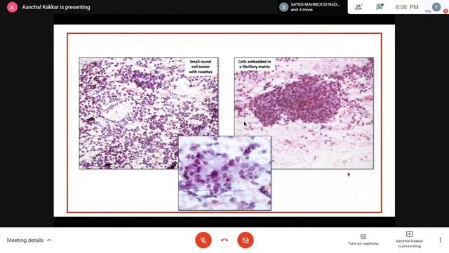 Pursue 13 D (Live): Pathology of Head & Neck :Salivary gland neoplasm : Expect the Unexpected смотреть онлайн