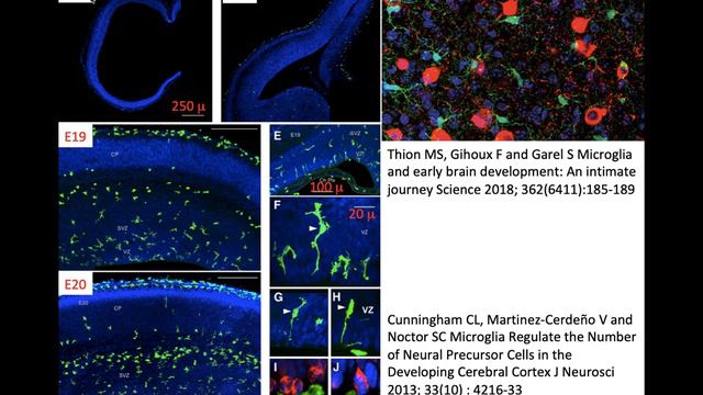 62.  Glioblastoma And Astrocytoma IDH-mutant Grade 4; GBM, Tumor Microenvironment, Immunotherapy