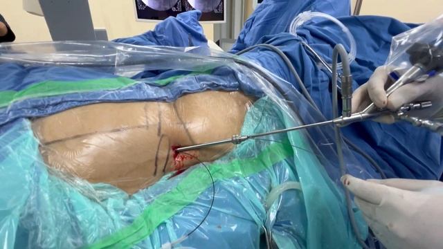 Enhanced super-Mini-PCNL for a 2cm oelvic stone смотреть онлайн