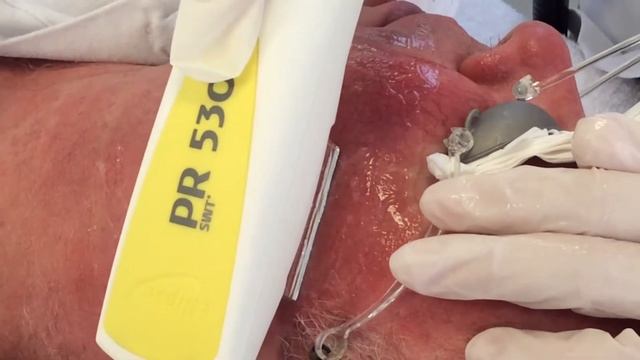 Nordlys Facial Telangiectasia treatment with Nordlys PR530 смотреть онлайн