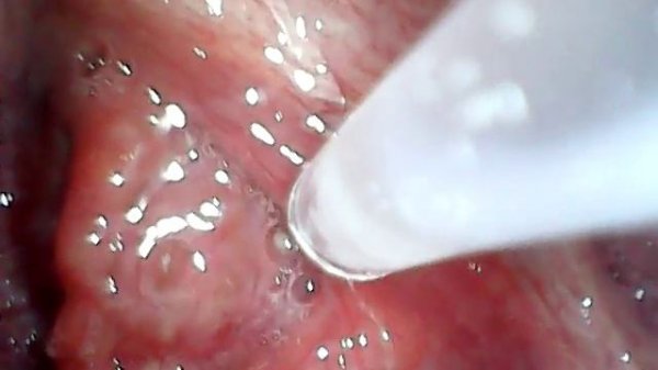 Извлечение тонзиллитной пробки