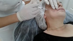 Поднятие  опущенных  уголков губ с помощью иньекций  филера