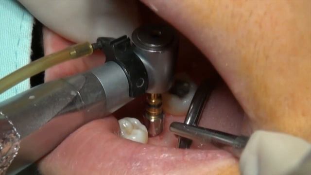 Установка имплантата AnyOne Xpeed в область 46 зуба. смотреть онлайн