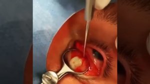 Pimple popping | Cyst popping | Глаз | Фурункул | Жесть | Ужасы | Страшно | Гной | Мерзко | Acne